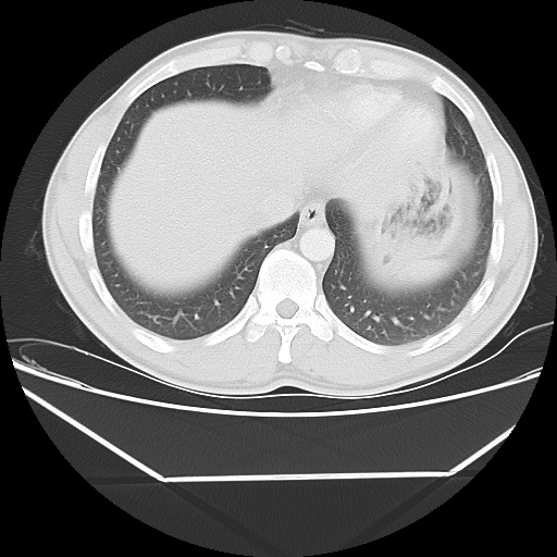 File:Aneurysmal bone cyst - rib (Radiopaedia 82167-96220 Axial lung window 52).jpg