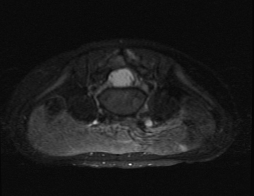File:Aneurysmal bone cyst - sacrum (Radiopaedia 65190-74196 Axial T2 fat sat 1).jpg