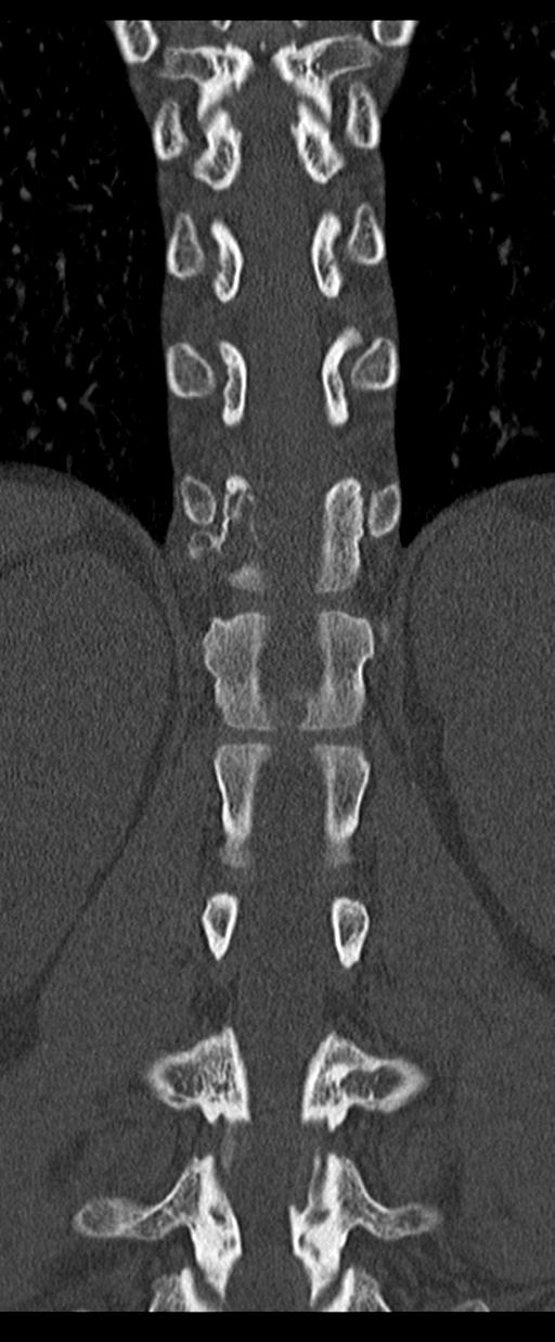 Aneurysmal bone cyst T11 (Radiopaedia 29294-29721 Coronal bone window 38).jpg