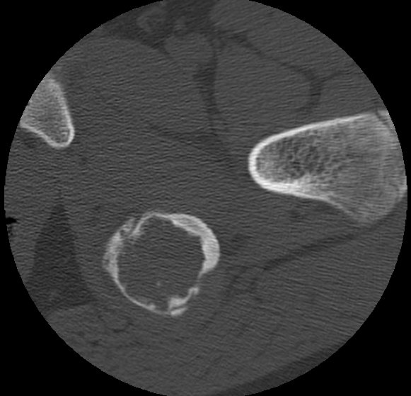 Aneurysmal bone cyst of ischium (Radiopaedia 25957-26094 B 32).png