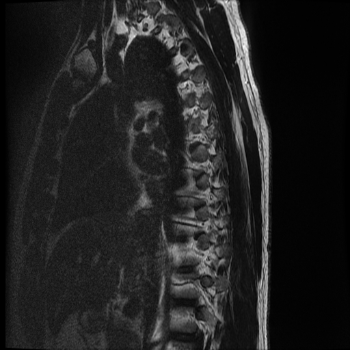 File:Angiolipoma - thoracic spine (Radiopaedia 28242-28479 Sagittal T2 13).jpg
