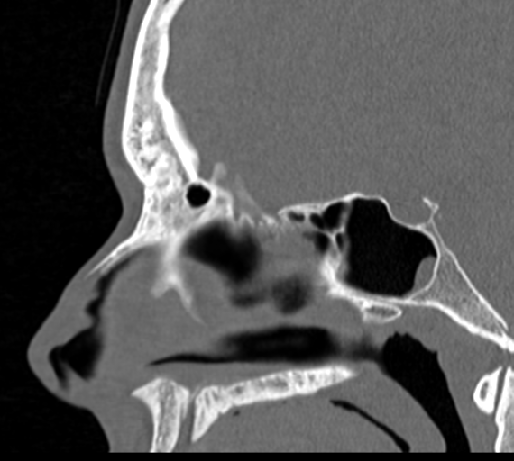 Angular epidermoid cyst (Radiopaedia 46908-51439 Sagittal bone window 44).png