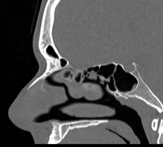 Angular epidermoid cyst (Radiopaedia 46908-51439 Sagittal bone window 47).png