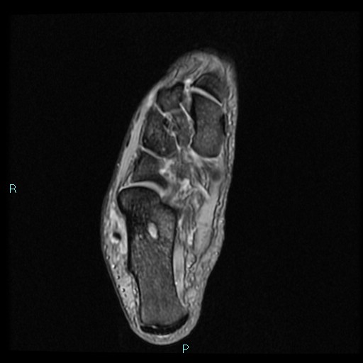 Ankle ganglion cyst (Radiopaedia 62809-71162 Axial Gradient Echo 27).jpg