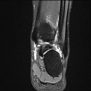 Ankle syndesmotic injury (Radiopaedia 69066-78837 Coronal PD fat sat 22).jpg
