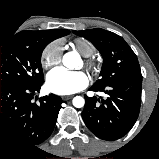 Anomalous left coronary artery from the pulmonary artery (ALCAPA) (Radiopaedia 70148-80181 A 130).jpg