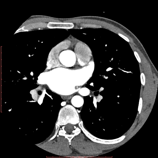 Anomalous left coronary artery from the pulmonary artery (ALCAPA) (Radiopaedia 70148-80181 A 84).jpg