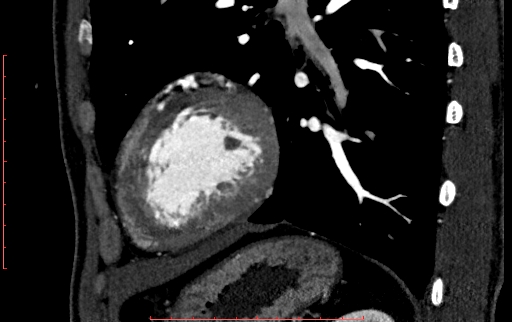 File:Anomalous left coronary artery from the pulmonary artery (ALCAPA) (Radiopaedia 70148-80181 C 200).jpg