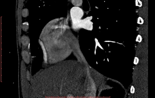 File:Anomalous left coronary artery from the pulmonary artery (ALCAPA) (Radiopaedia 70148-80181 C 30).jpg