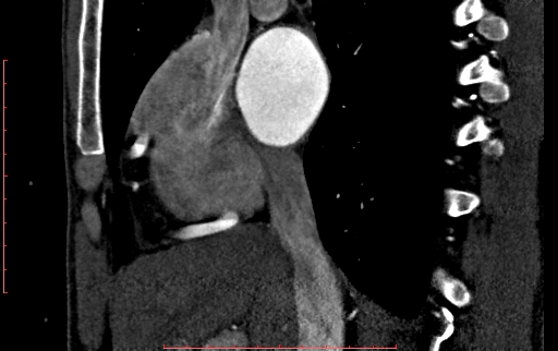 Anomalous left coronary artery from the pulmonary artery (ALCAPA) (Radiopaedia 70148-80181 C 55).jpg