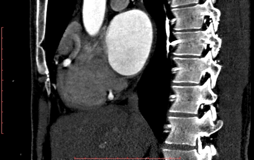 File:Anomalous left coronary artery from the pulmonary artery (ALCAPA) (Radiopaedia 70148-80181 C 79).jpg