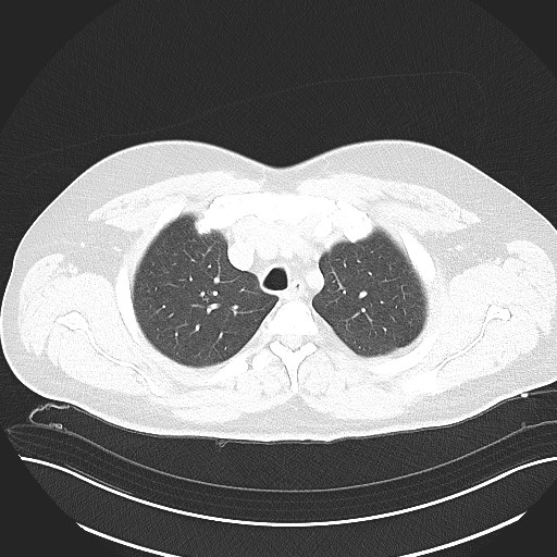 File:Anomalous origin of the left coronary artery with malignant course (Radiopaedia 77842-90126 Axial lung window 9).jpeg