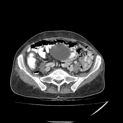 Anorectal carcinoma (Radiopaedia 44413-48064 A 39).jpg