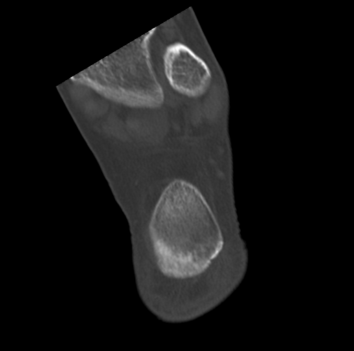 Anterior calcaneal process fracture (Radiopaedia 47384-51989 Coronal bone window 71).png