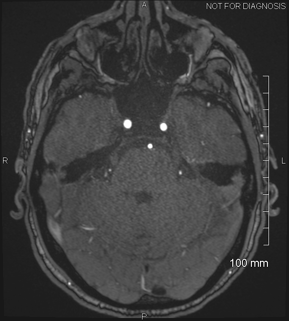Anterior cerebral artery aneurysm (Radiopaedia 80683-94127 Axial MRA 68).jpg