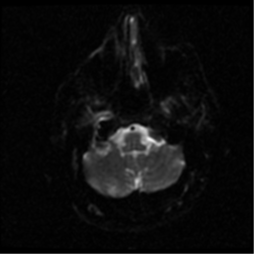 File:Anterior cerebral artery territory infarct (Radiopaedia 39327-41584 Axial DWI 29).png