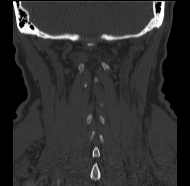 Anterior cervical postdiscectomy arthrodesis (Radiopaedia 32678-33646 Coronal bone window 58).jpg