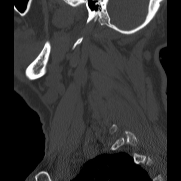 Anterior cervical postdiscectomy arthrodesis (Radiopaedia 32678-33646 Sagittal bone window 72).jpg