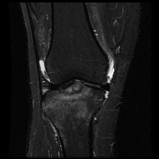 File:Anterior cruciate ligament avulsion fracture (Radiopaedia 58939-66193 Coronal STIR 8).jpg