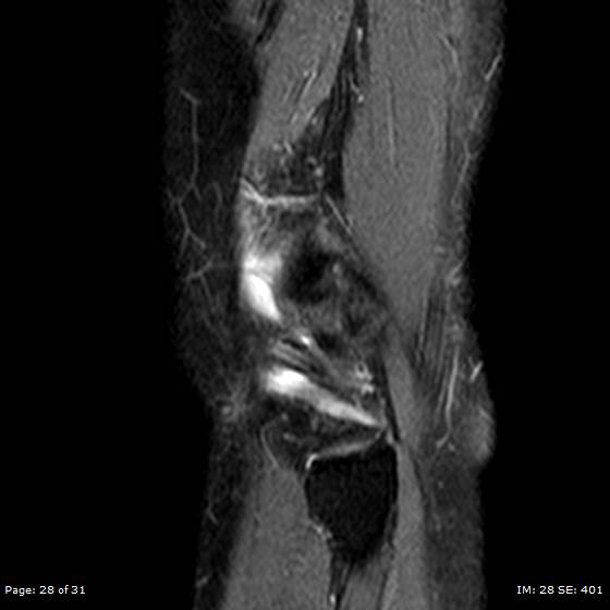 File:Anterior cruciate ligament tear (Radiopaedia 70783-80964 Sagittal STIR 28).jpg