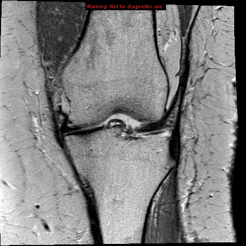 File:Anterior cruciate ligament tear - complete (Radiopaedia 12175-12514 C 7).jpg