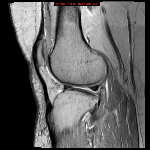 File:Anterior cruciate ligament tear - complete (Radiopaedia 12175-12514 Sagittal PD 6).jpg