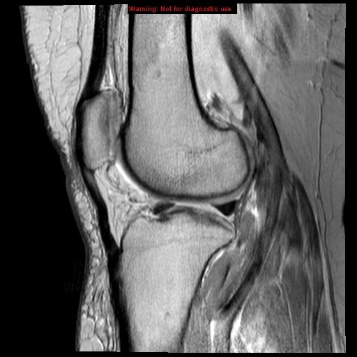 File:Anterior cruciate ligament tear - complete (Radiopaedia 12175-12514 Sagittal PD 8).jpg