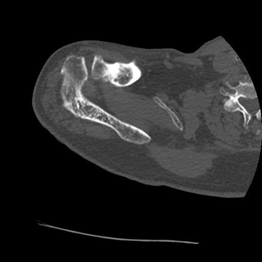 Anterior glenohumeral dislocation with Hill-Sachs lesion (Radiopaedia 62877-71249 Axial bone window 15).jpg