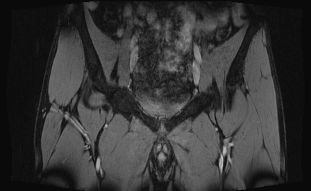 Anterior inferior iliac spine avulsion fracture (Radiopaedia 81312-95000 G 71).jpg