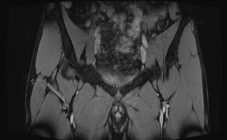 Anterior inferior iliac spine avulsion fracture (Radiopaedia 81312-95000 G 72).jpg