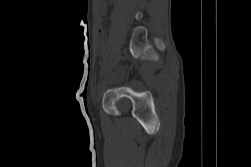Anterior inferior iliac spine avulsion injury (Radiopaedia 88666-105376 Sagittal bone window 36).jpg