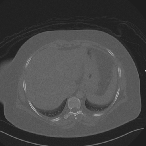 Anterior superior iliac spine avulsion fracture (Radiopaedia 44541-48244 Axial bone window 18).png