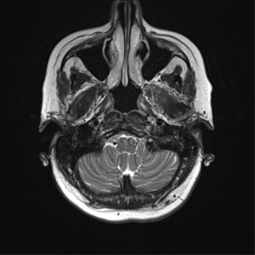 File:Anterior temporal lobe perivascular space (Radiopaedia 40946-43650 Axial T2 5).png