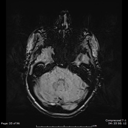 File:Anterior temporal lobe perivascular space (Radiopaedia 88283-104914 Axial SWI 4).jpg