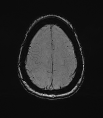 Anterior temporal pole cysts (Radiopaedia 46629-51102 Axial SWI 72).png