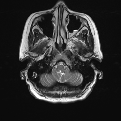File:Anterior temporal pole cysts (Radiopaedia 46629-51102 C 6).png