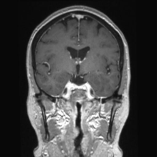 Anterior temporal pole cysts (Radiopaedia 46629-51102 Coronal T1 C+ 97).png