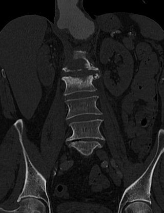 Anterior vertebral scalloping (abdominal aortic aneurysm) (Radiopaedia 66744-76067 Coronal bone window 31).jpg