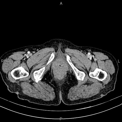 File:Aortic aneurysm and Lemmel syndrome (Radiopaedia 86499-102554 A 87).jpg