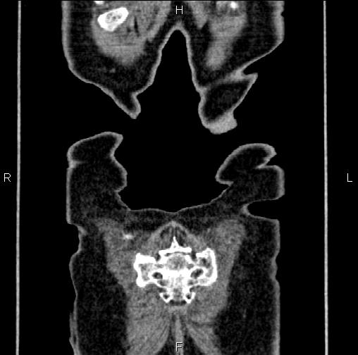 Aortic aneurysm and Lemmel syndrome (Radiopaedia 86499-102554 C 68).jpg