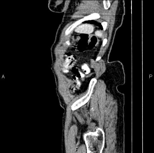 File:Aortic aneurysm and Lemmel syndrome (Radiopaedia 86499-102554 D 84).jpg