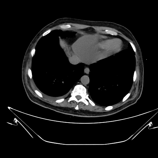 Aortic arch aneurysm (Radiopaedia 84109-99365 Axial non-contrast 221).jpg