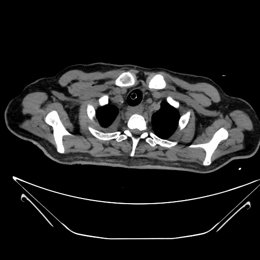 Aortic arch aneurysm (Radiopaedia 84109-99365 Axial non-contrast 38).jpg