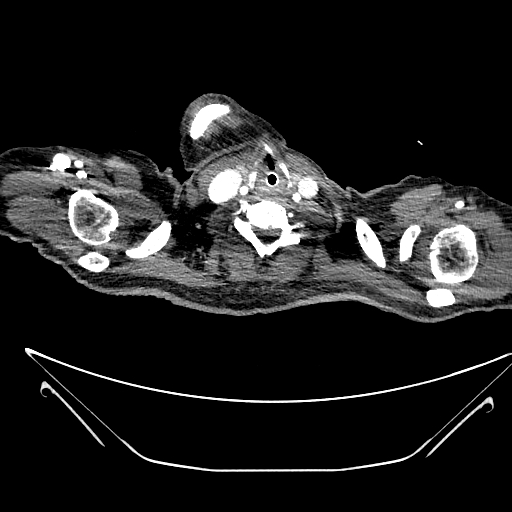 Aortic arch aneurysm (Radiopaedia 84109-99365 B 1).jpg