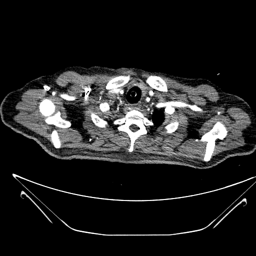 Aortic arch aneurysm (Radiopaedia 84109-99365 B 66).jpg