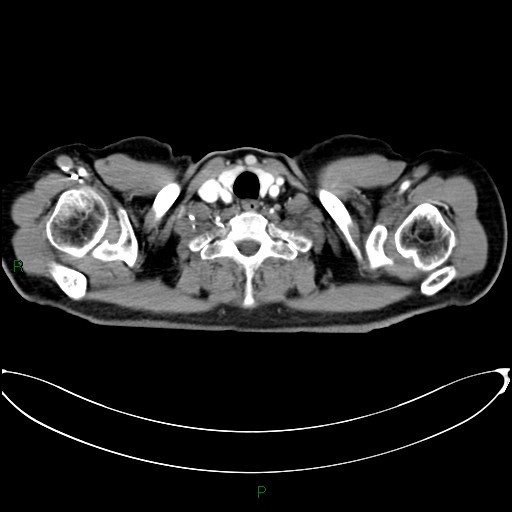 Aortic arch origin of left vertebral artery (Radiopaedia 46327-50737 Axial post contrast 4).jpg