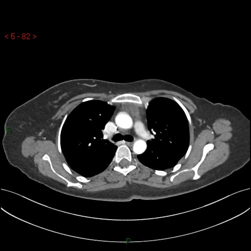 File:Aortic arch origin of left vertebral artery (Radiopaedia 51520-57286 A 81).jpg
