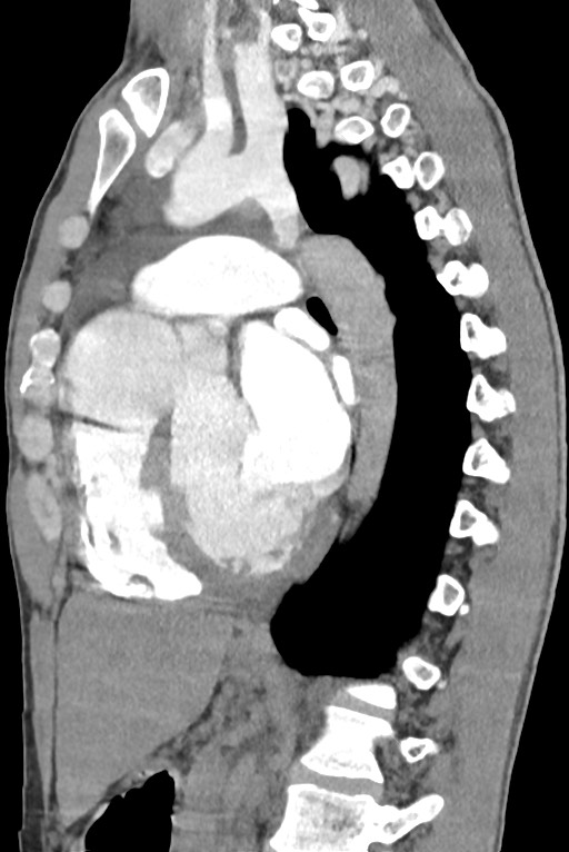 Aortic coarctation with aneurysm (Radiopaedia 74818-85828 B 94).jpg