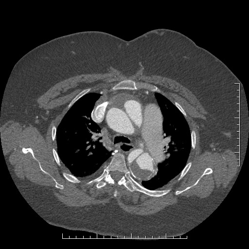 File:Aortic dissection- Stanford A (Radiopaedia 35729-37268 A 25).jpg