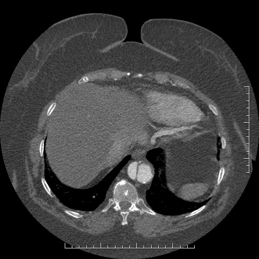 File:Aortic dissection- Stanford A (Radiopaedia 35729-37268 B 16).jpg